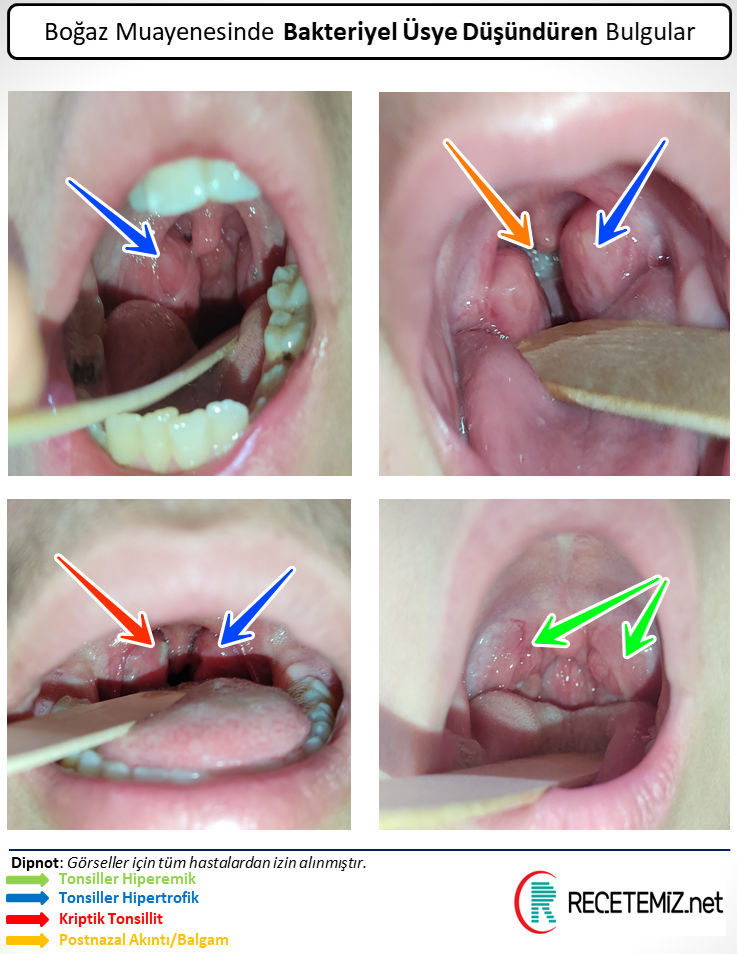 Bakteriyel Üsye / Kriptik Tonsillit