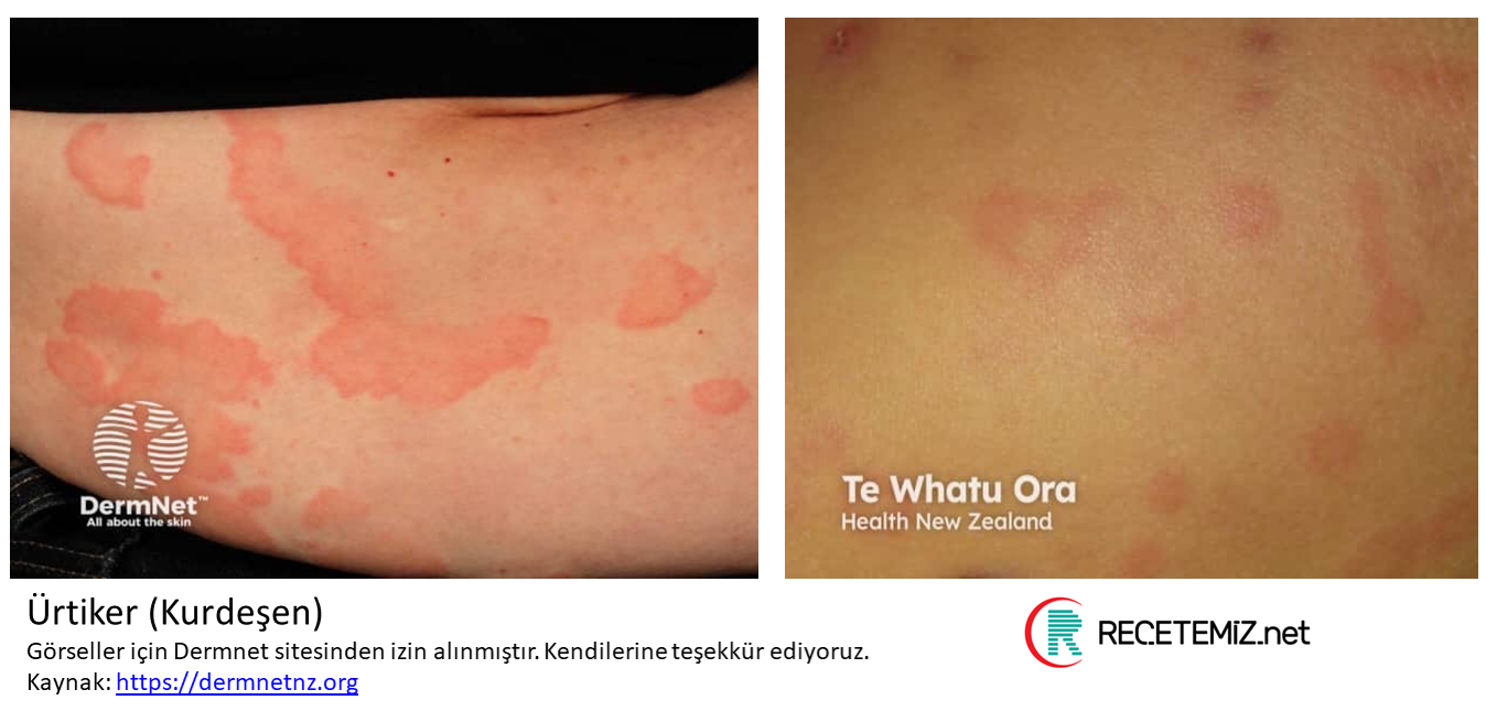 Ürtiker (Kurdeşen)