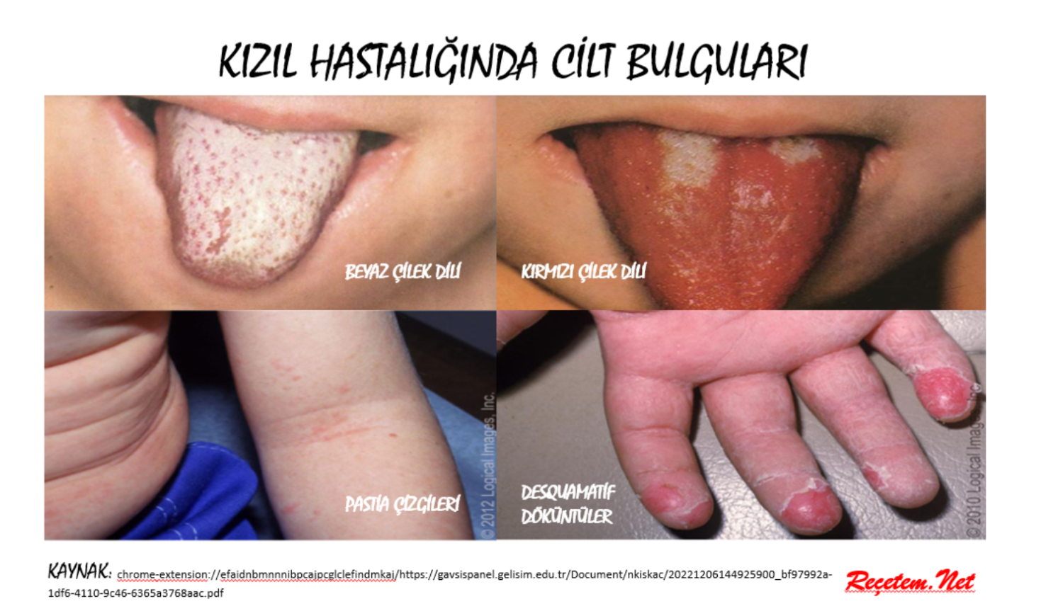 Kızıl Hastalığında Cilt Bulguları