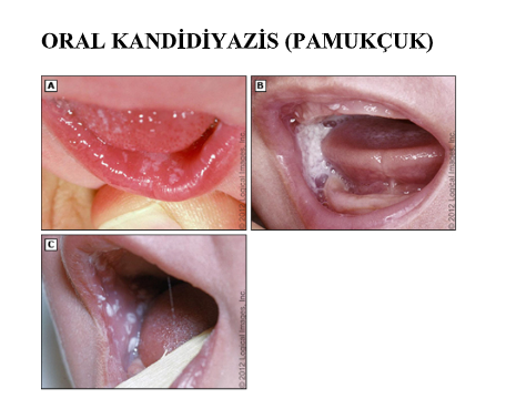 Oral Kandidiyaz (Pamukçuk)