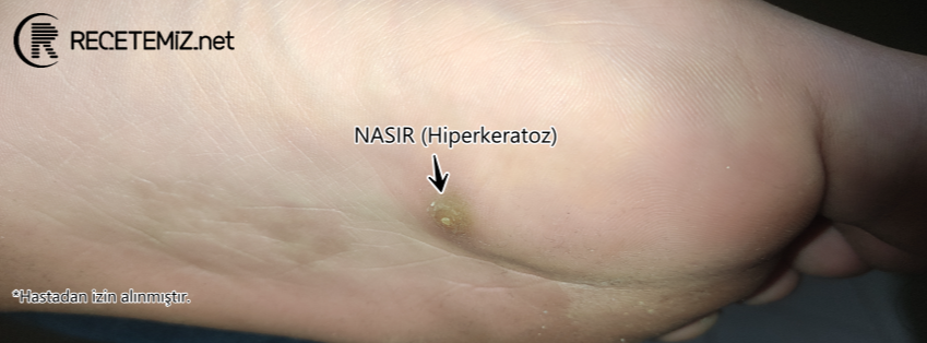 Ayak Tabanında Nasır