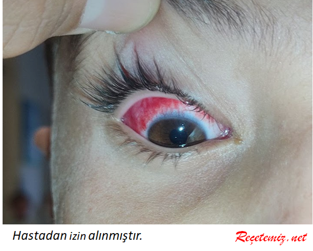 Subkonjonktival Hemoraji