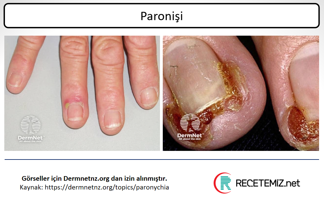 Paronişi (Dolama) Reçetesi